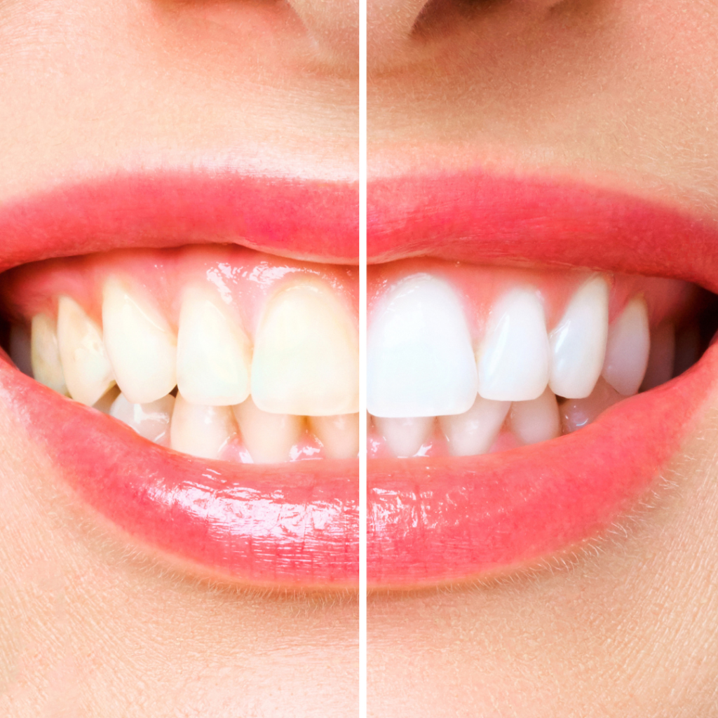 resultado blanqueamiento dental