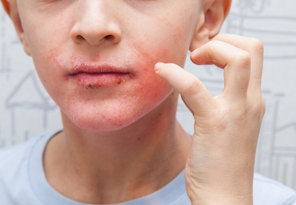tratamiento-rosacea-torrevieja