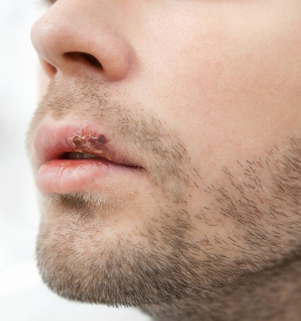 herpes genital herpes labial
