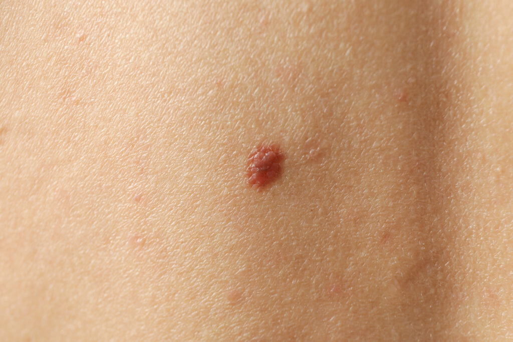 herpes genital herpes labial