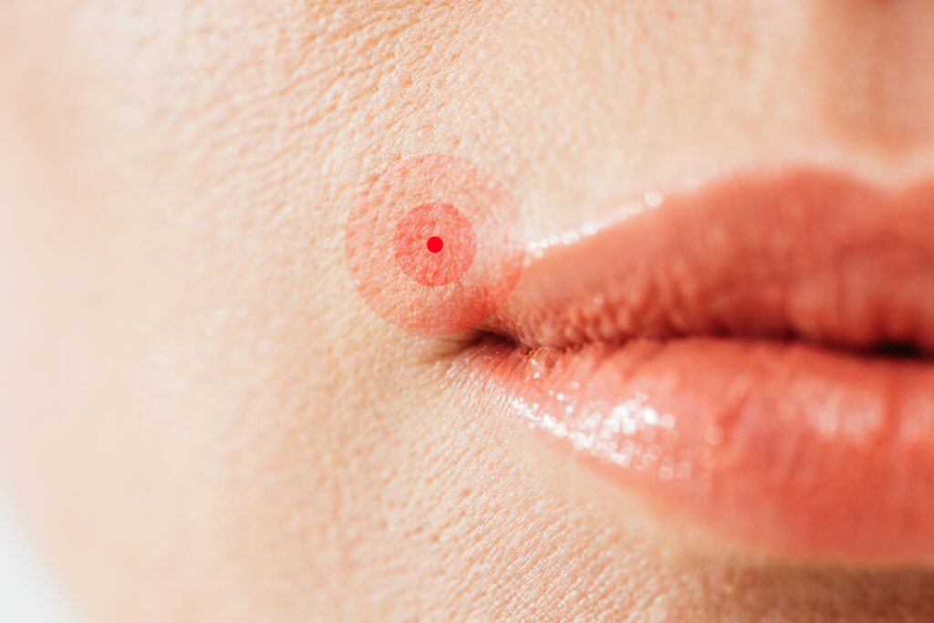 herpes genital herpes labial