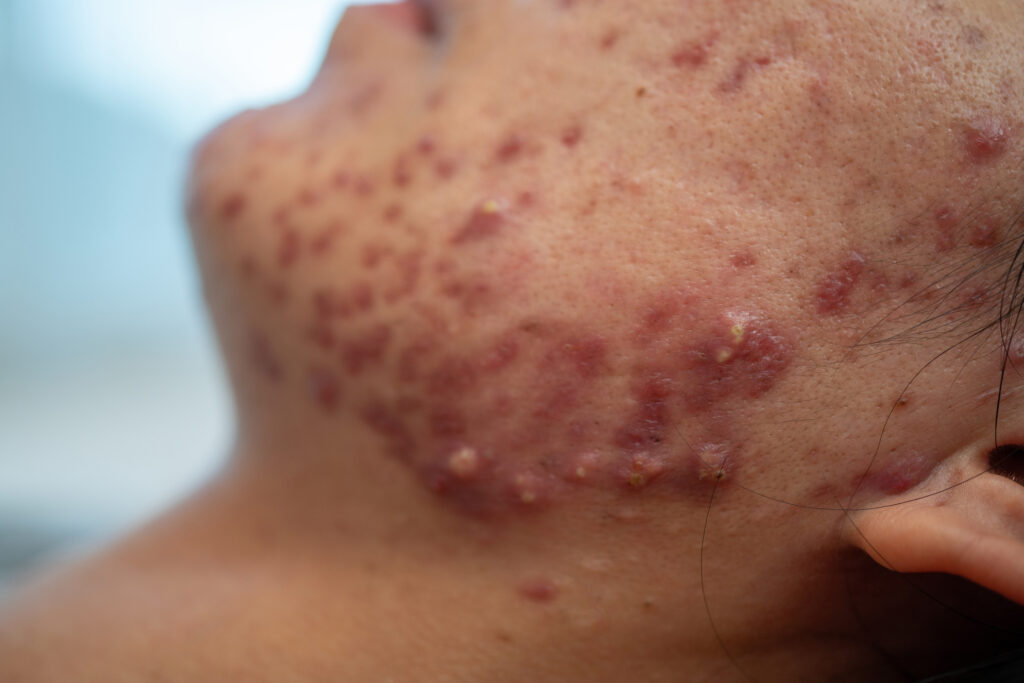 tratamiento-acne-torrevieja