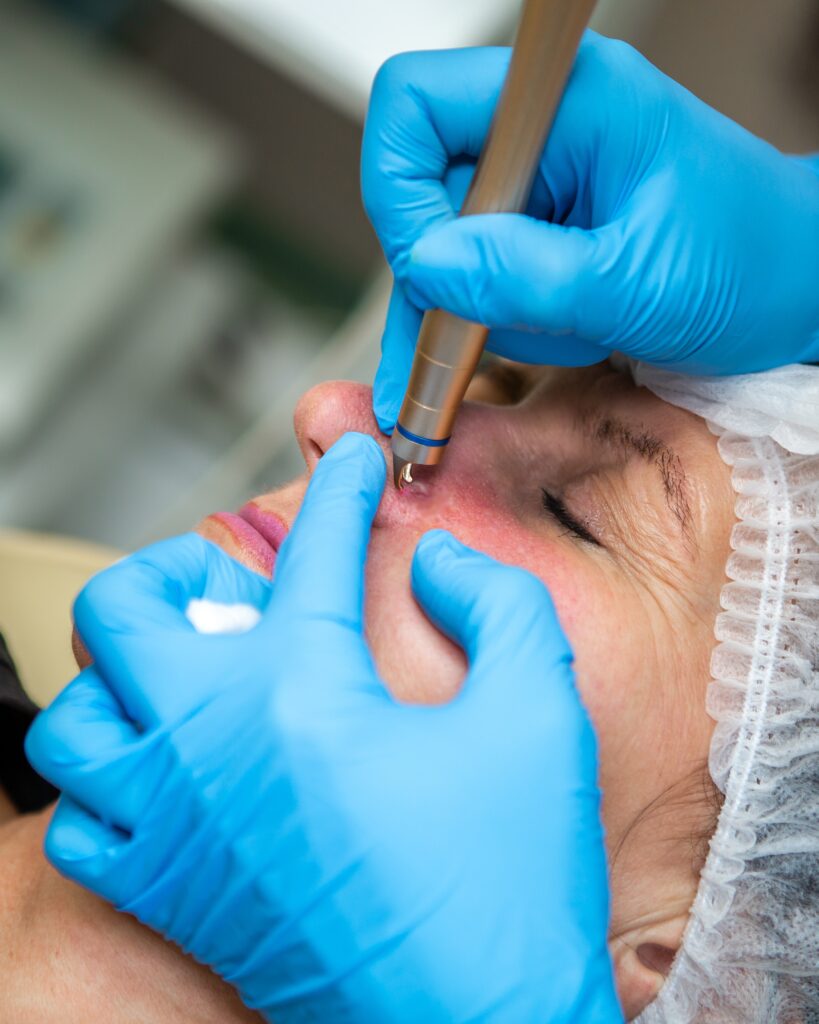 tratamiento-acne-torrevieja