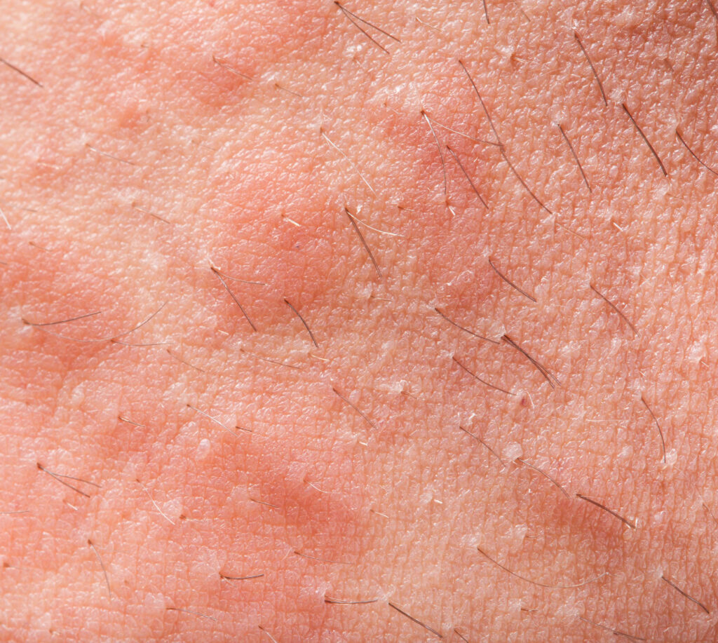 Foliculitis y Forúnculos en Torrevieja