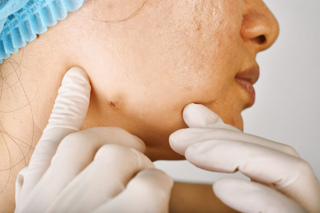 Foliculitis y Forúnculos en Torrevieja