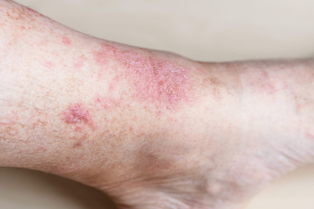 Foliculitis y Forúnculos en Torrevieja