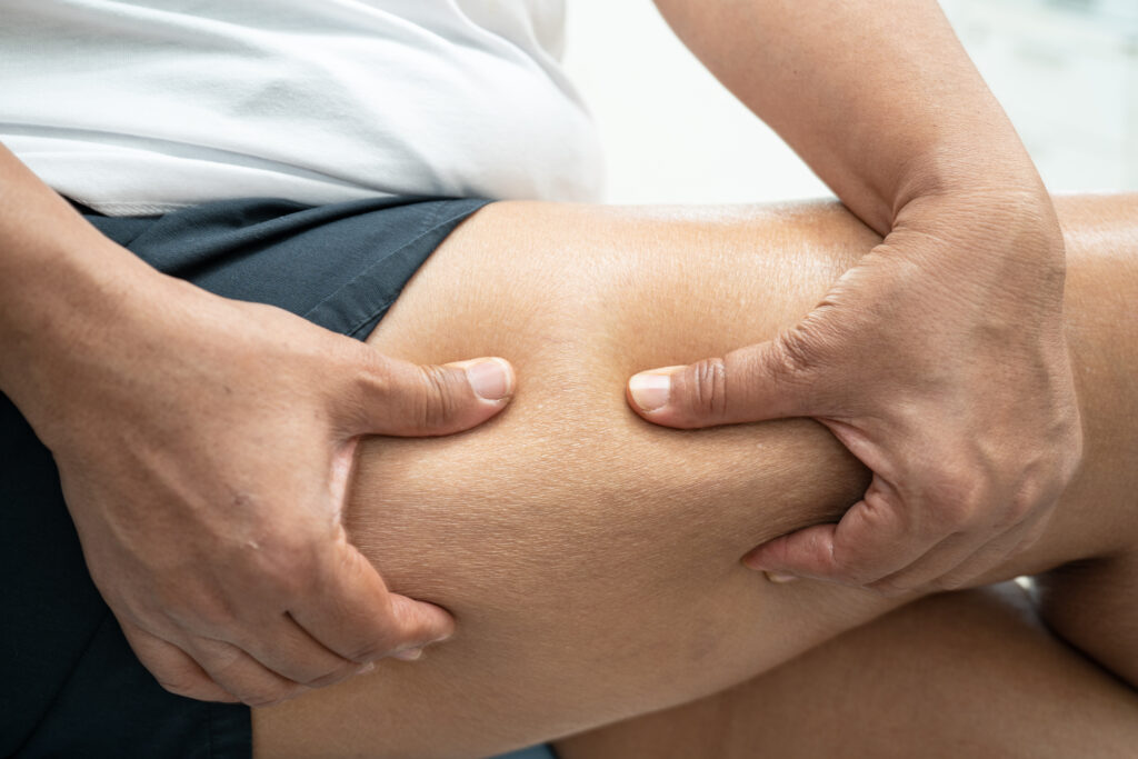 celulitis-en-torrevieja