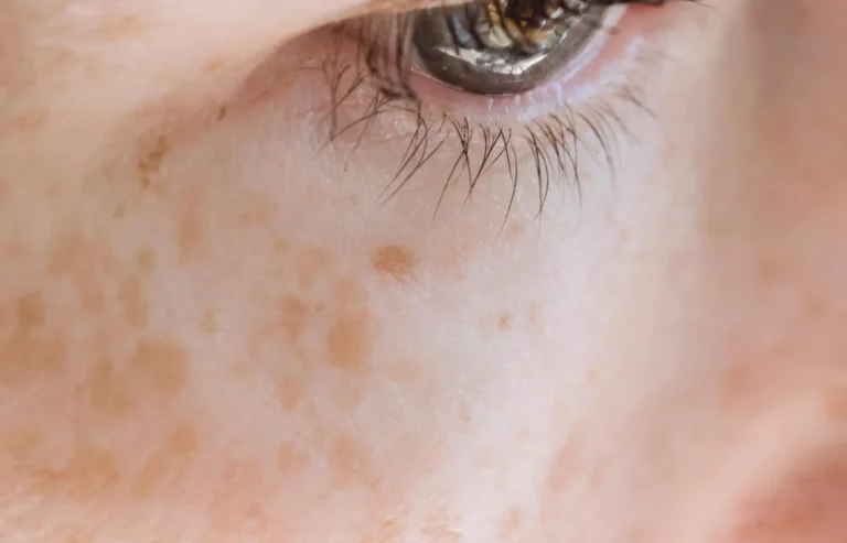 Piel con melasma ligero para tratar en nuestra clínica de Torrevieja