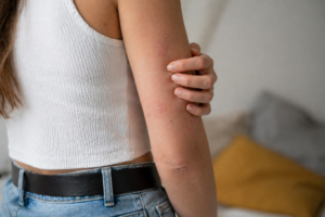 Una mujer señala los signos de psioriasis en su brazo derecho