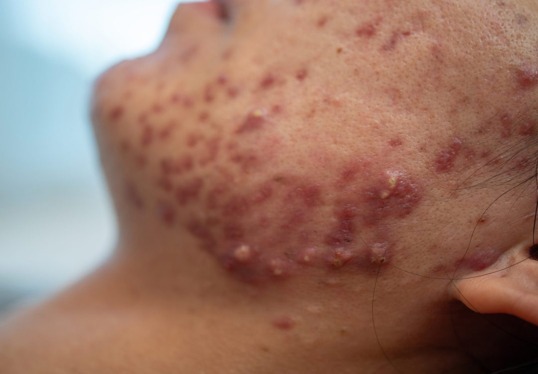 Foliculitis y Forúnculos en Torrevieja