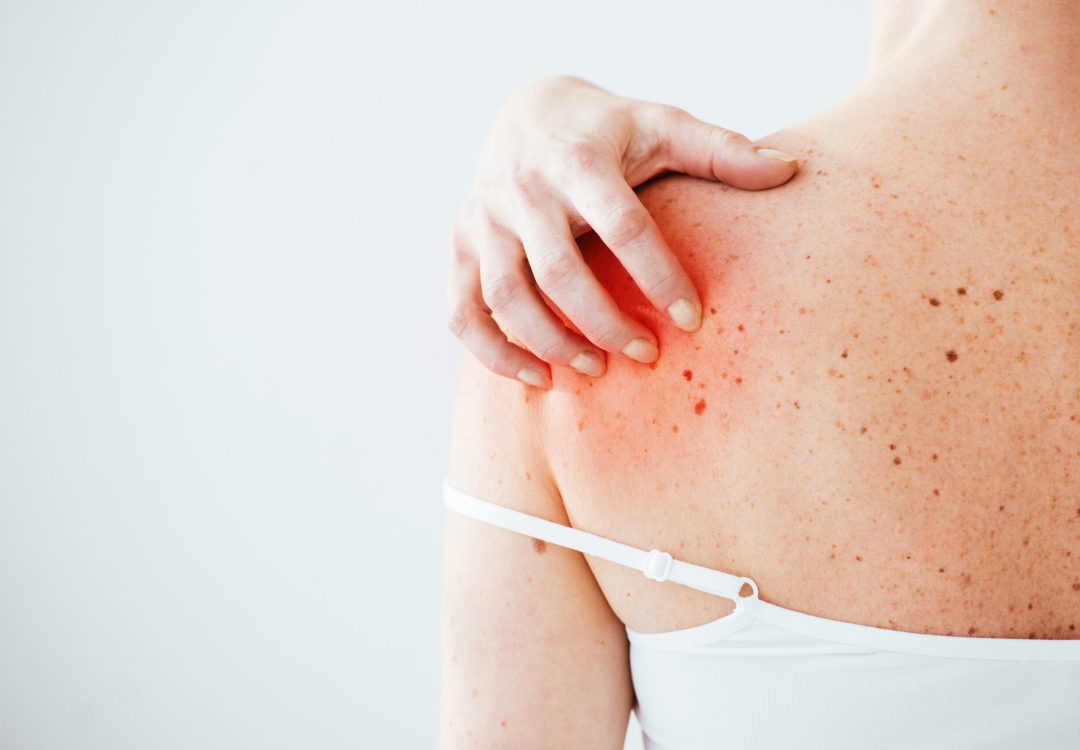Foliculitis y Forúnculos en Torrevieja