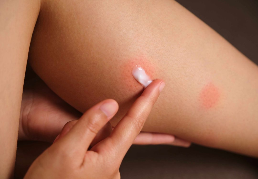celulitis-en-torrevieja