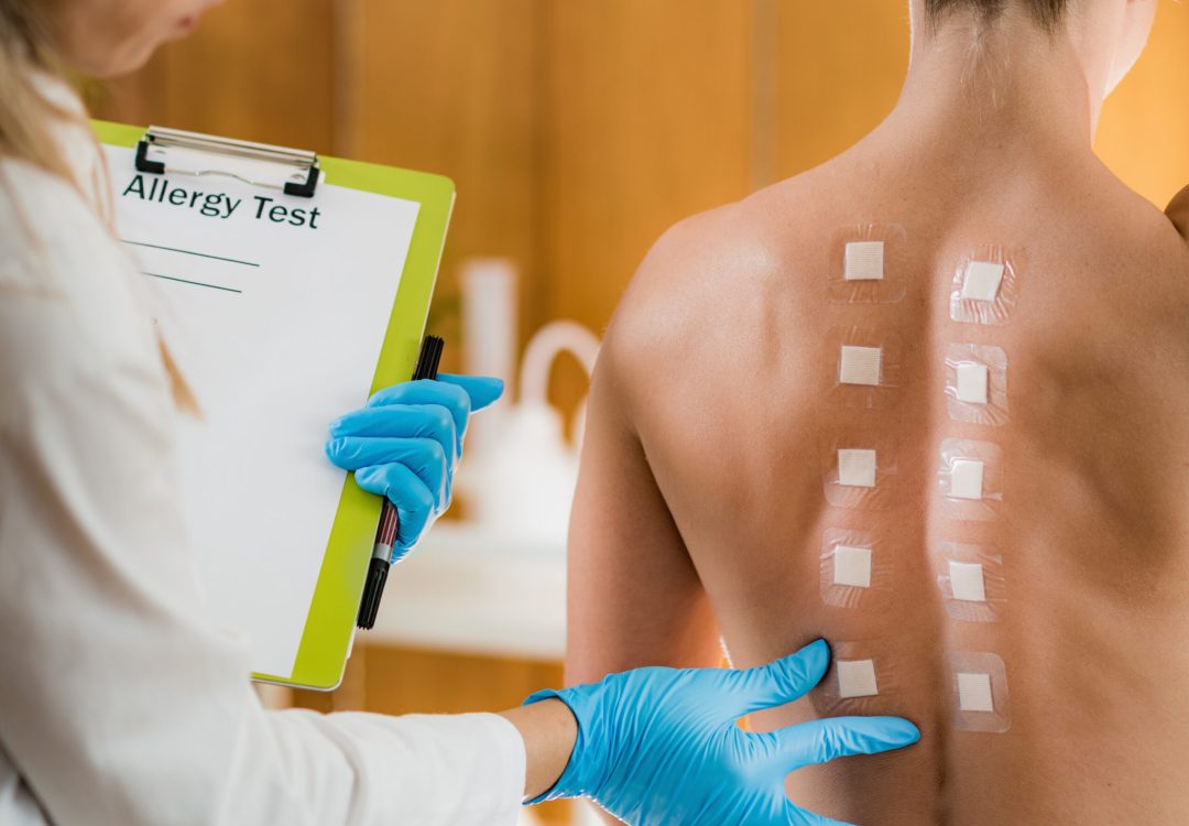 Immunologist Doing Skin Prick Allergy Test on a Woman’s Back