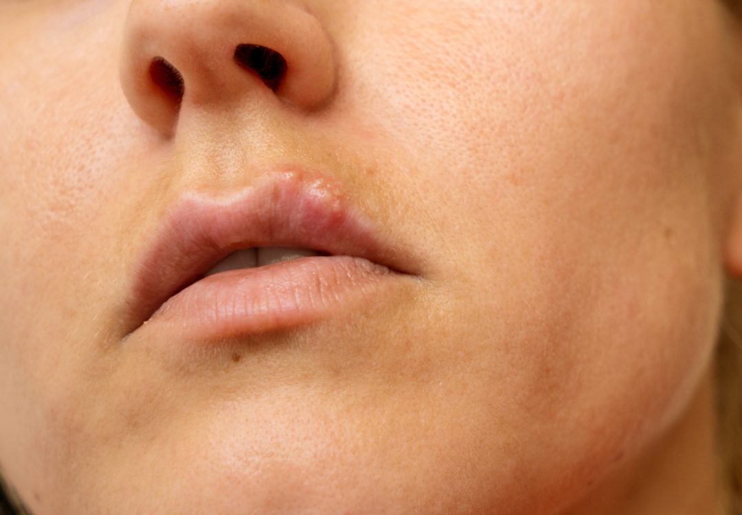herpes genital herpes labial