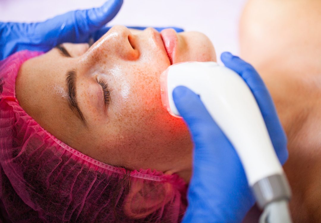 tratamiento-acne-torrevieja