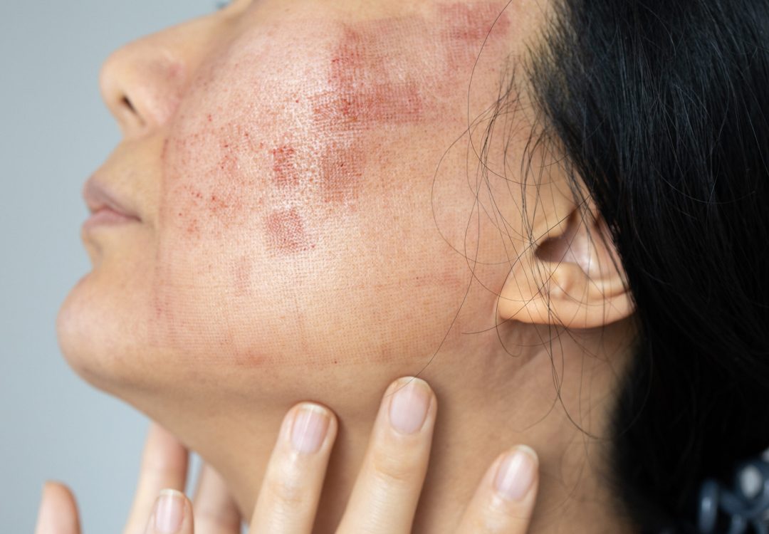 tratamiento-rosacea-torrevieja